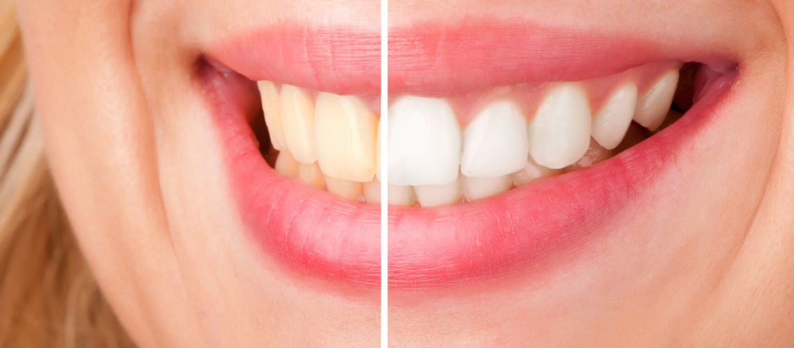 Tooth Whitening