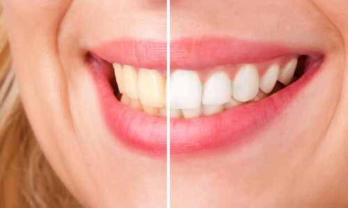 Tooth Whitening